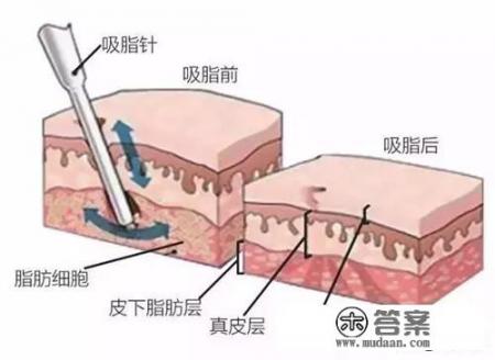 怎样吸脂减肥？qto吸脂是什么？