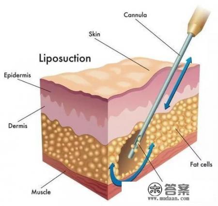吸脂减肥大约多少钱？吸脂减肥手术的价格是多少？