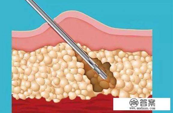 吸脂是什么？