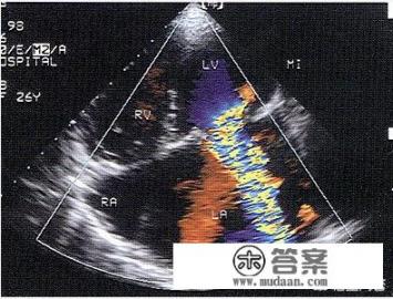 医生说的二尖瓣返流是啥