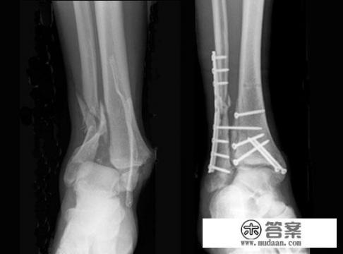 左腿胫腓骨双骨折拆了钢板多久后才能剧烈运动？应该注意哪些细节