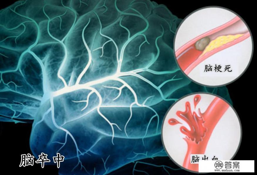 脑卒中家庭护理指南