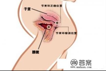 55岁了，节育环要去掉吗？在体内会有什么影响