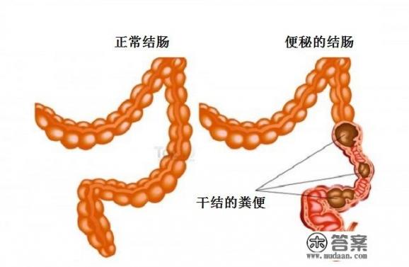 便秘都是什么原因引起的，如何缓解便秘