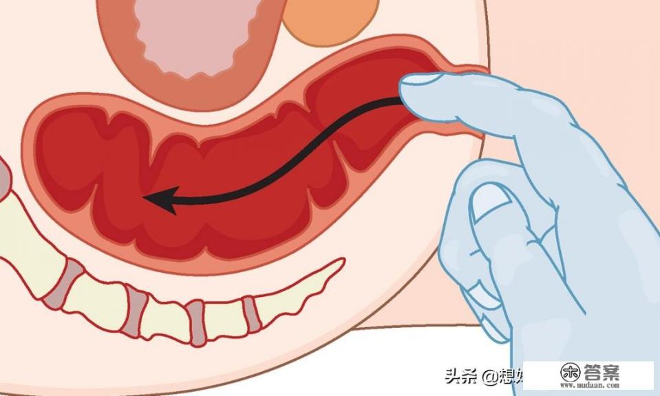 腹部触诊怎么做_作为体检项目，肛门指检到底有没有用