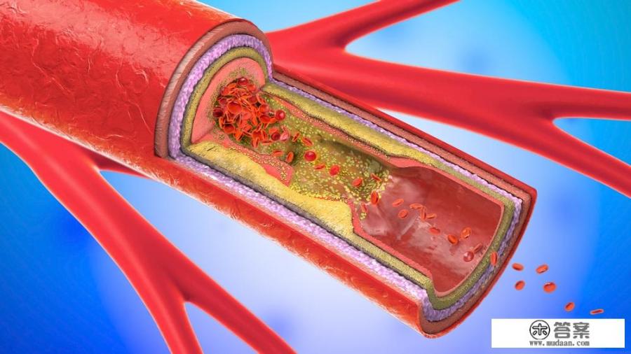血管堵塞，身体会有哪几处“疼痛”_血管堵塞怎么快速清理