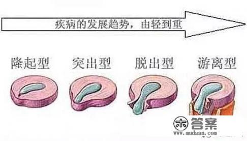 中医药外敷可以完全治好生不如死的腰椎突出吗