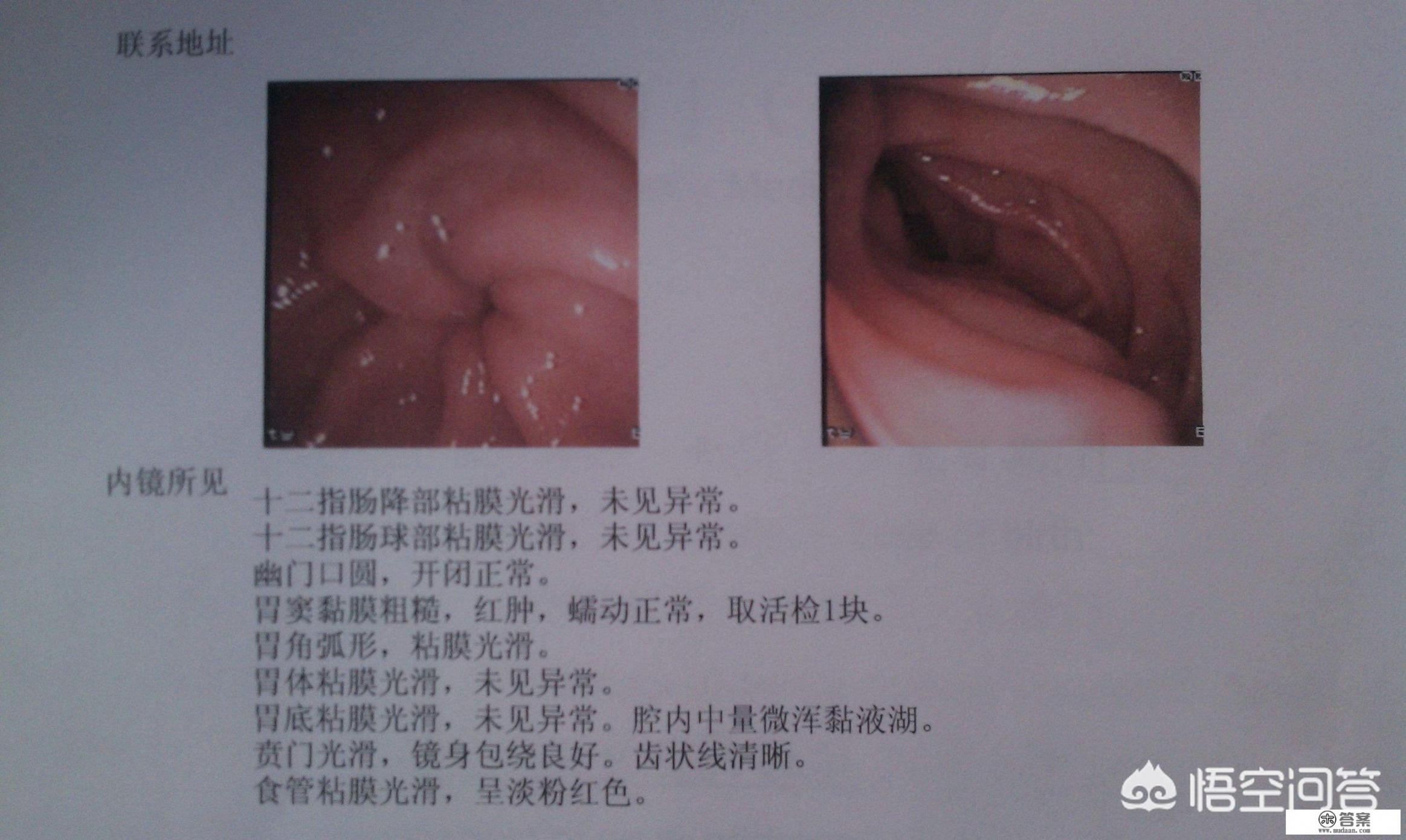 慢性胃炎的症状表现