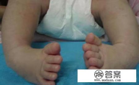 马蹄足可以选用运动康复法吗 马蹄足可以选用运动康复法吗