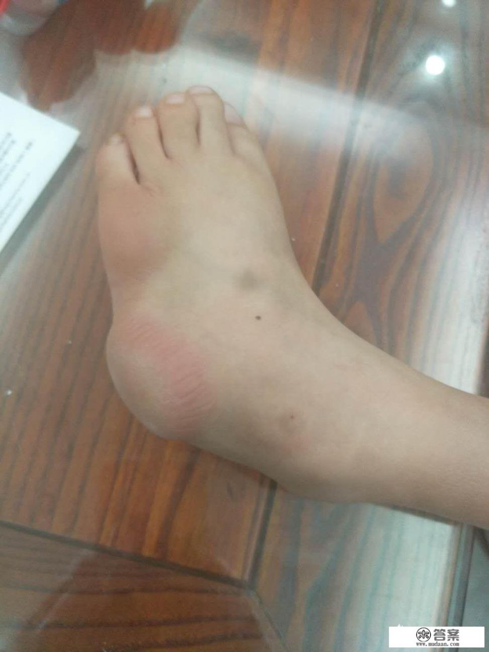 马蹄足可以选用运动康复法吗 马蹄足可以选用运动康复法吗