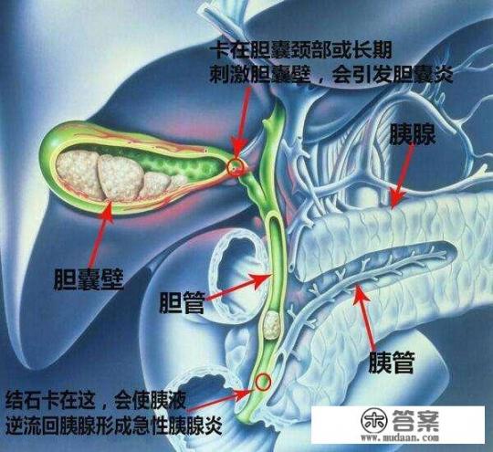 哪些水果适合结石患者食用？