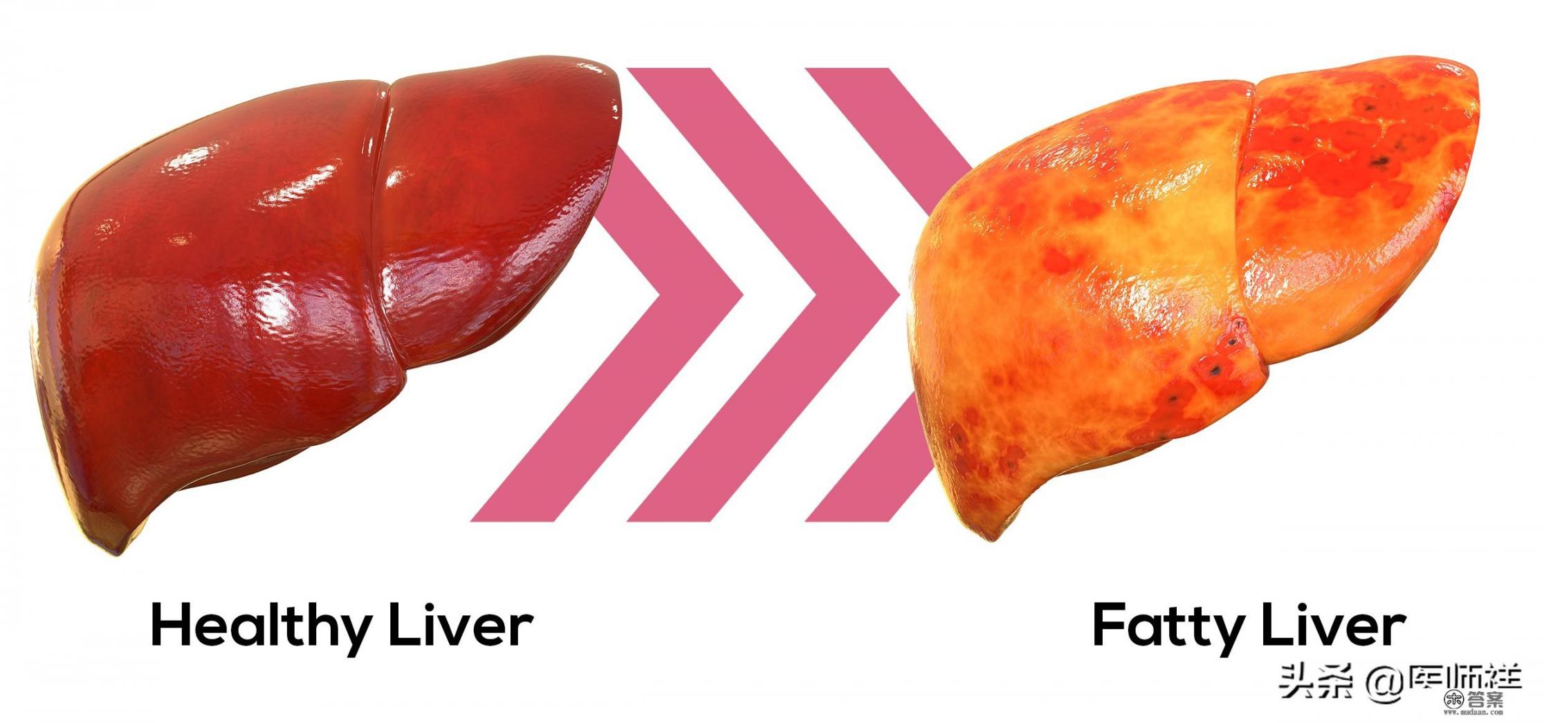 什么是脂肪肝如何治疗？