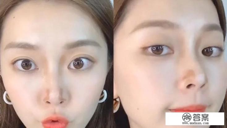 蒜头鼻怎么修？