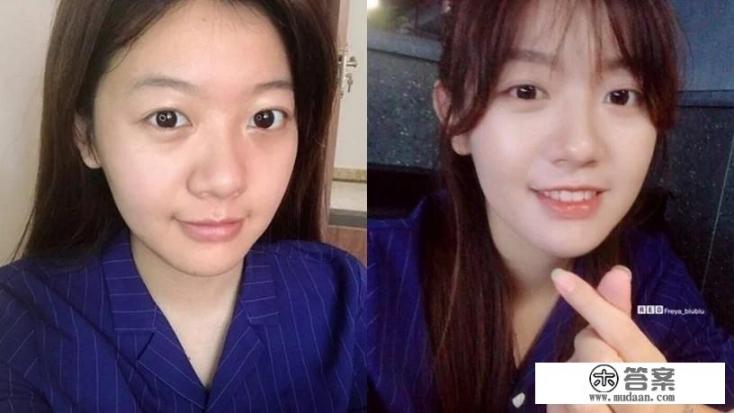 蒜头鼻怎么修？