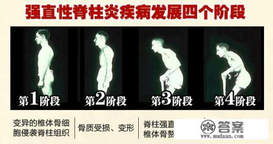 强直性脊柱炎会不会引起牙疼？