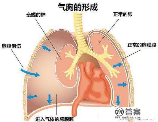 气胸的表现是什么？