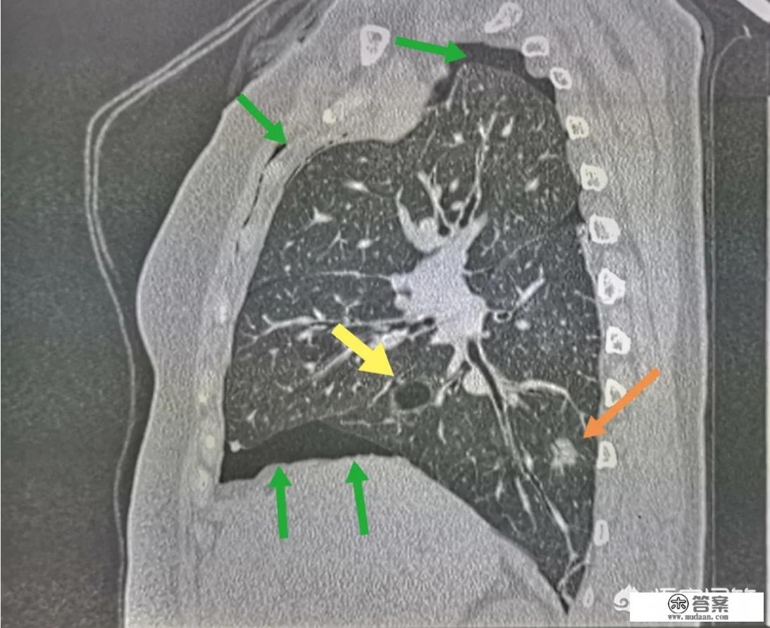 气胸如何处理？