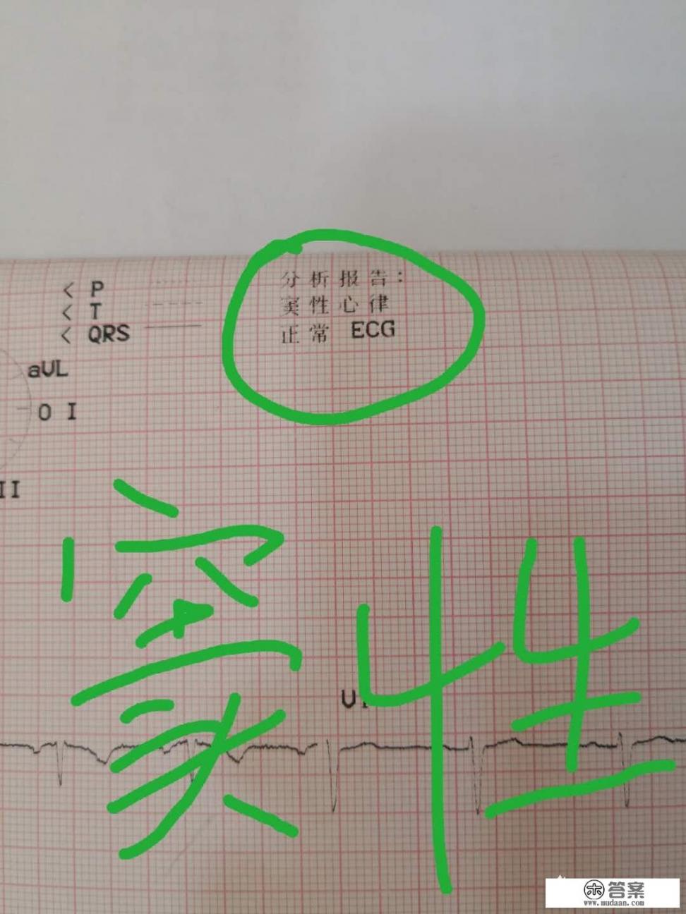 窦性心律是什么？