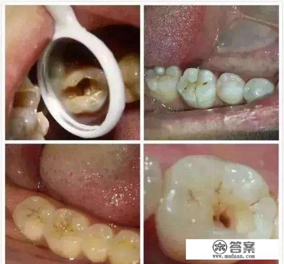 蛀牙引起的疼痛个耳鸣，怎么办？