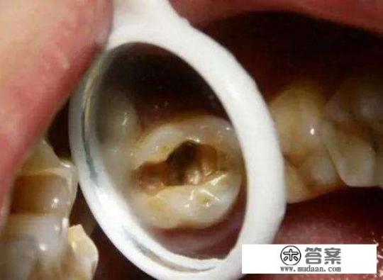 蛀牙引起的疼痛个耳鸣，怎么办？