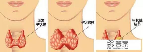 甲状腺结节是恶性的怎么办? 甲状腺结节是恶性的怎么办?