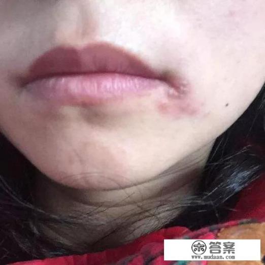 嘴角起泡怎么回事？