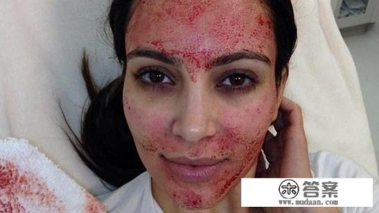 玻尿酸注射去皱美容能管大概多长时间啊？