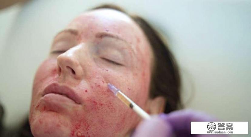 玻尿酸注射去皱美容能管大概多长时间啊？