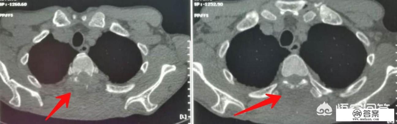 皮肤基底细胞癌初期症状是什么？