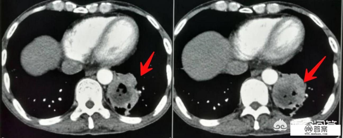 皮肤基底细胞癌初期症状是什么？