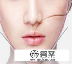 面部吸脂术手术过程介绍？面部吸脂手术过程详解？面部吸脂手术过程中，详细步骤和效果描述是什么？