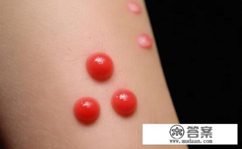 艾滋病初期皮疹的现象是什么呢？艾滋病初期皮疹症状有哪些?