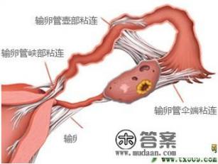 输卵管粘连是怎么造成的？该注意些什么？