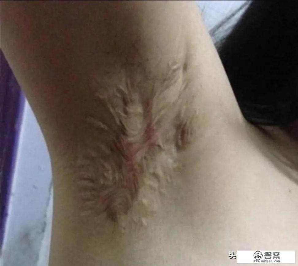 做腋下汗腺切除手术要挂什么科？