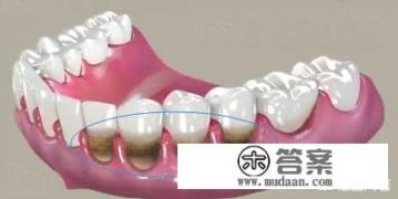 牙龈萎缩有什么药可以吃? 牙龈萎缩有什么药可以吃?