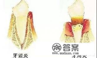 牙龈萎缩有什么药可以吃? 牙龈萎缩有什么药可以吃?