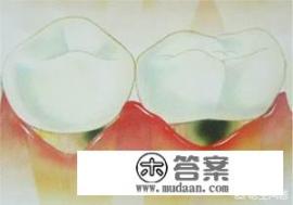 牙龈萎缩有什么药可以吃? 牙龈萎缩有什么药可以吃?