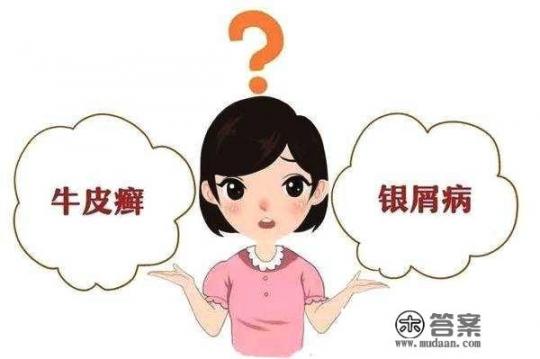 牛皮癣和体癣一样吗,如何区别牛皮癣和体癣? 牛皮癣和体癣一样吗,如何区别牛皮癣和体癣?