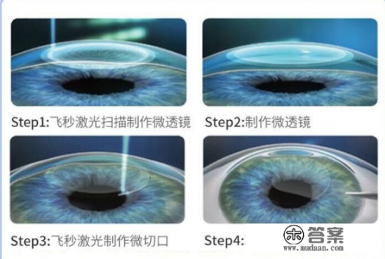 近视眼手术有哪几种？