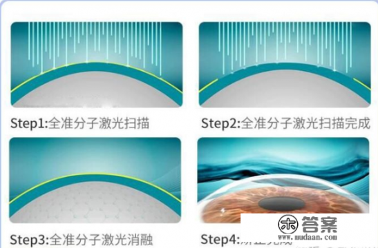 近视眼手术有哪几种？