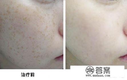 激光祛斑效果？