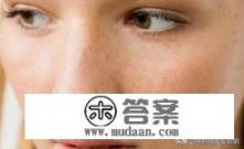 激光祛斑效果？