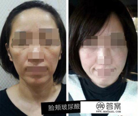 皮肤松弛下垂法令纹深该怎么办? 皮肤松弛下垂法令纹深该怎么办?