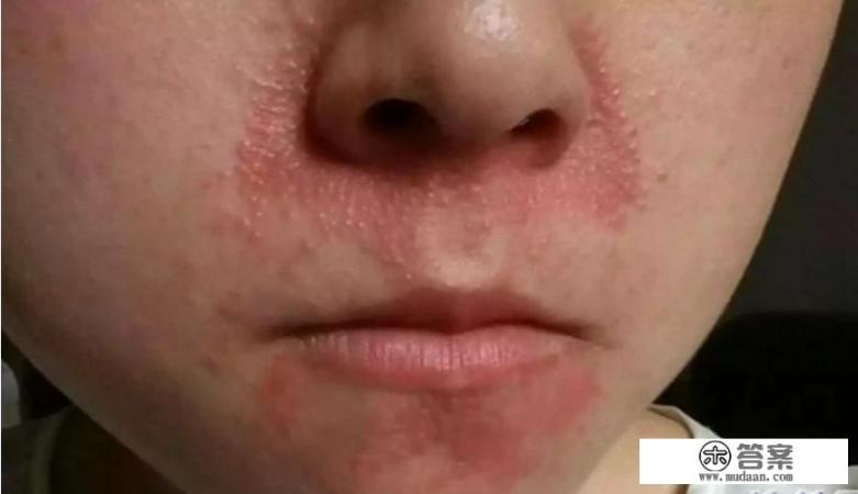 农村常说的顽疾“羊胡子”是什么? 农村常说的顽疾“羊胡子”是什么?