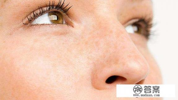 祛除黄褐斑最有效的好方法是什么？