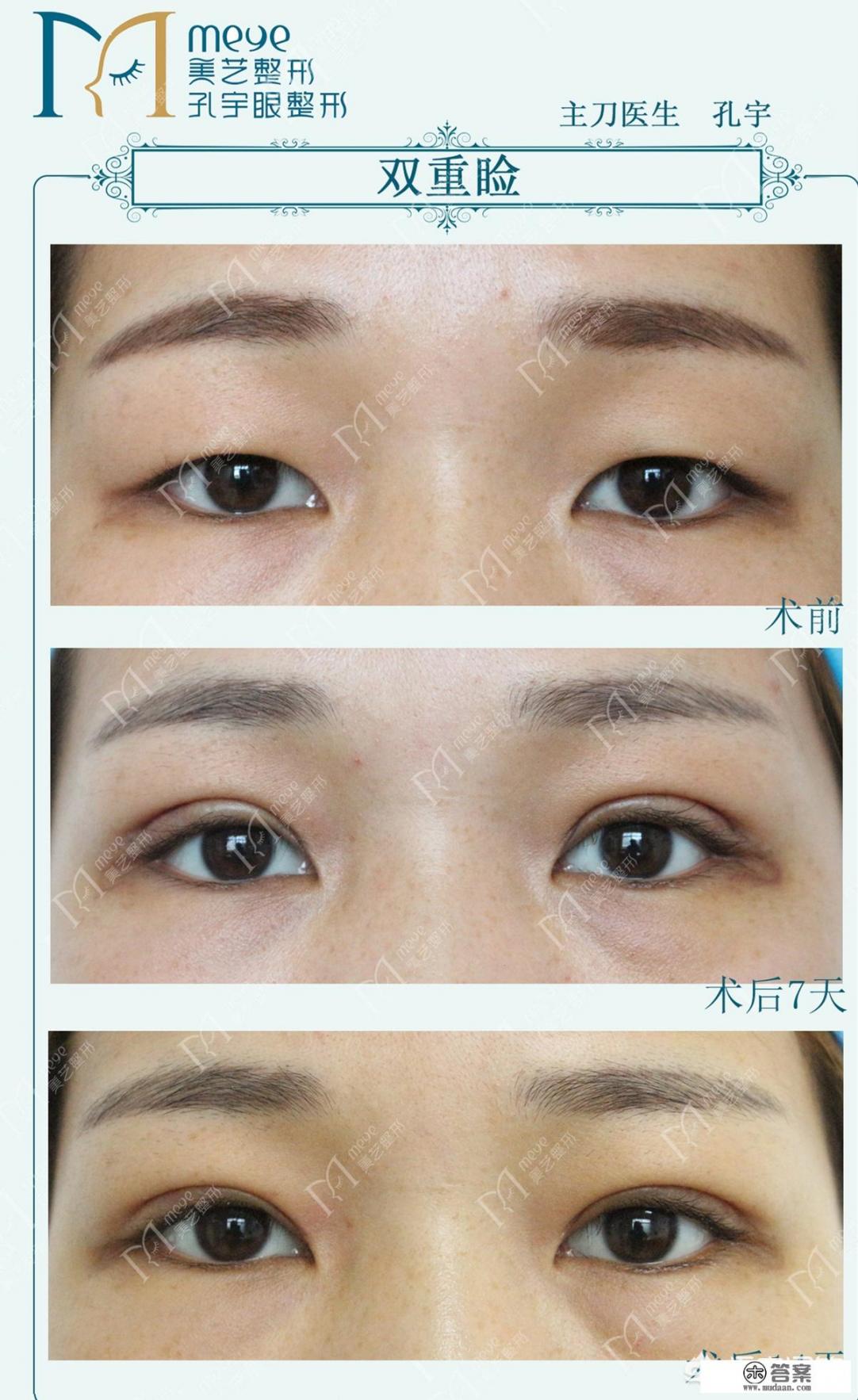 眼部整形都包括哪些? 眼部整形都包括哪些?