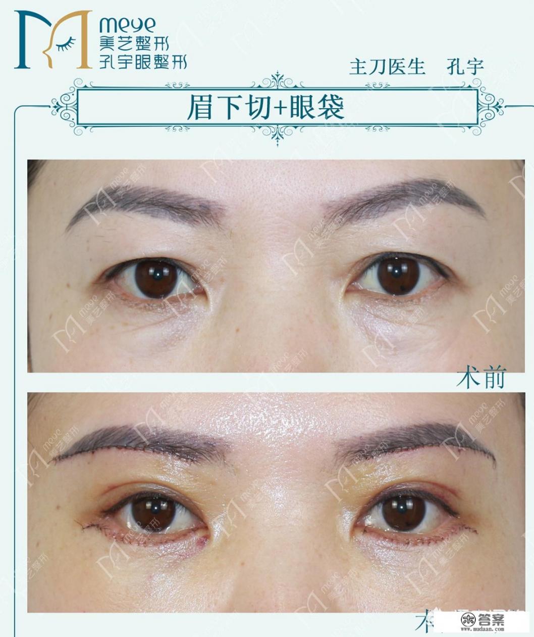 眼部整形都包括哪些? 眼部整形都包括哪些?