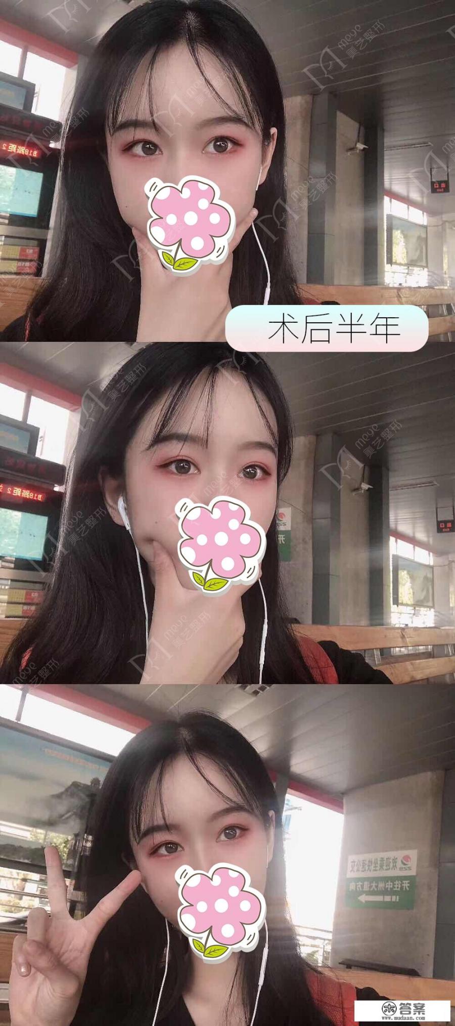 想做个双眼皮，哪家医院好？