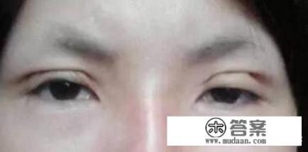 想做个双眼皮，哪家医院好？