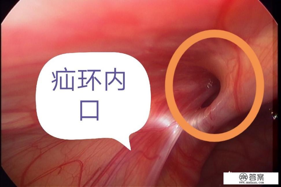 5岁多小孩疝气,哪种手术方式比较好?腹腔镜手术真的好吗? 5岁多小孩疝气,哪种手术方式比较好?腹腔镜手术真的好吗?